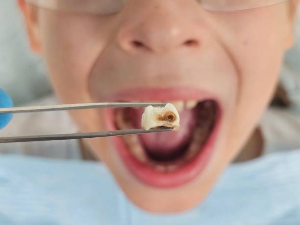 Best Emergency Dental Extractions in Lake Cassidy, WA