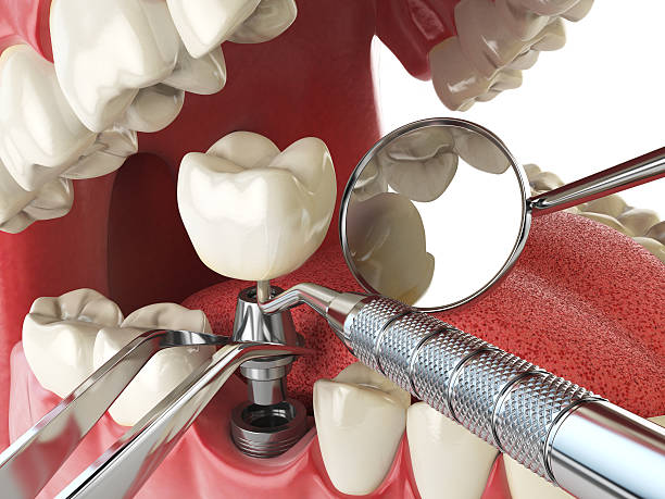 Best Emergency Dentist for Knocked-Out Tooth in Lake Cassidy, WA